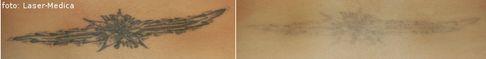 Tattoo removal - effects