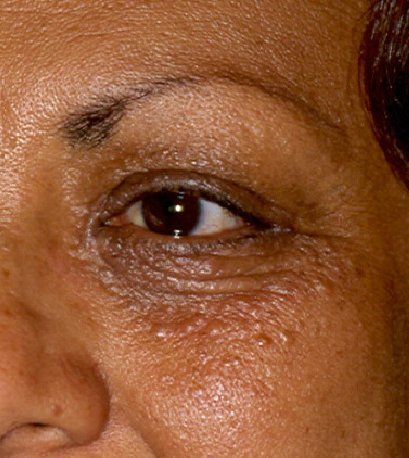 Eyelid Lesion Excision | West Texas Eye