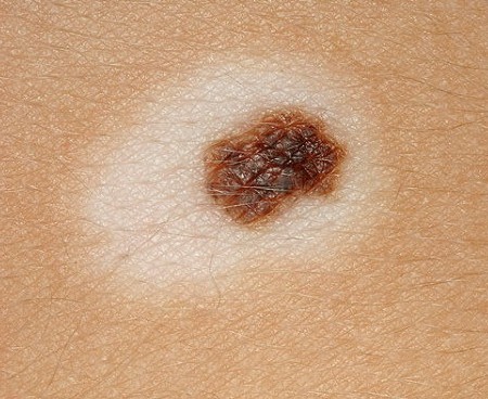 Skin Cancer: Symptoms, Treatment and Prevention of Skin ...