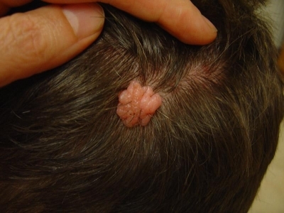 Epidermal Nevus Syndrome Clinical Presentation: History ...