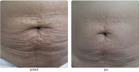 Accent Elite skin firming - post-treatment effects