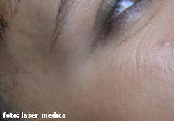 botox botox