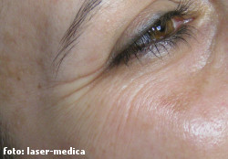 botox botox