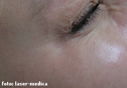 botox botox