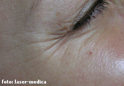 botox botox