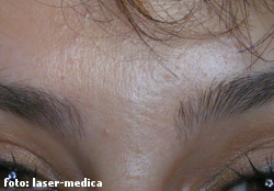 botox botox