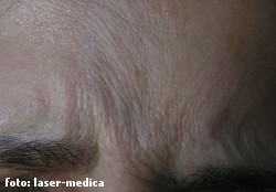 botox botox