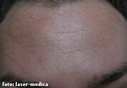 botox botox
