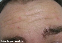 botox botox