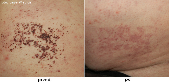 Removal of skin lesions; angiomas - effects