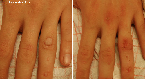 Removal of skin lesions; warts - effects
