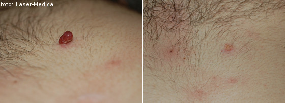Removal of skin lesions; warts - effects