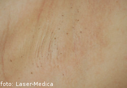 depilacja laserowa, laserowe usuwanie owłosienia