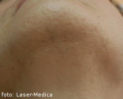 depilacja laserowa, laserowe usuwanie owłosienia