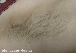 laserowe usuwanie owłosienia