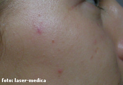 closing capillaries with laser