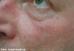 closing capillaries with laser