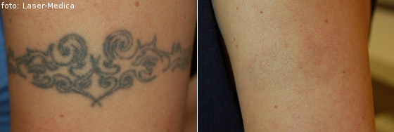 Tattoo removal - effects