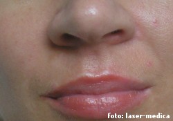 wrinkle removal - injectable fillers wrinkle removal