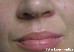 wrinkle removal - injectable fillers wrinkle removal