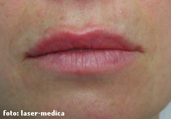 wrinkle removal - injectable fillers wrinkle removal