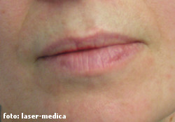 wrinkle removal - injectable fillers wrinkle removal