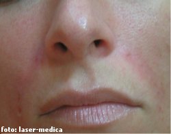 wrinkle removal - injectable fillers wrinkle removal