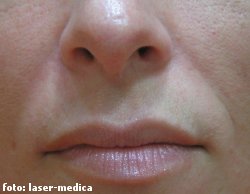 wrinkle removal - injectable fillers wrinkle removal