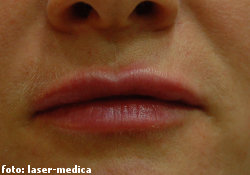 wrinkle removal - injectable fillers wrinkle removal