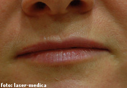 wrinkle removal - injectable fillers wrinkle removal
