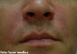 wrinkle removal - injectable fillers wrinkle removal