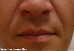 wrinkle removal - injectable fillers wrinkle removal