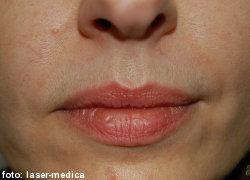 wrinkle removal - injectable fillers wrinkle removal