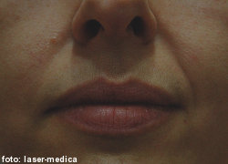 wrinkle removal - injectable fillers wrinkle removal