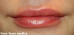 wrinkle removal - injectable fillers wrinkle removal