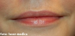 wrinkle removal - injectable fillers wrinkle removal