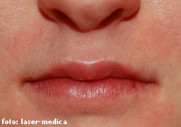 wrinkle removal - injectable fillers wrinkle removal