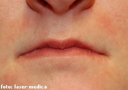 wrinkle removal - injectable fillers wrinkle removal
