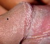 Pearly papules